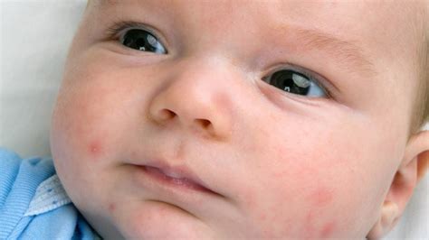Baby Acne What Is It How To Control