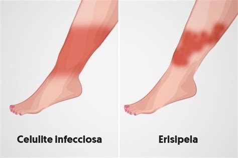 Infectious Cellulitis What It Is Symptoms Photos And Causes