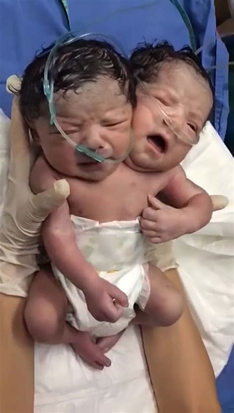 Baby With 2 Heads Born In Mexico Fox News