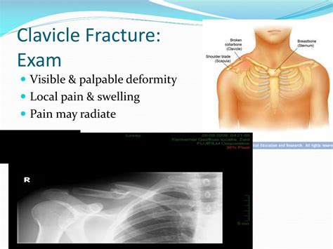 Ppt Common Fracture Management Powerpoint Presentation Free Download