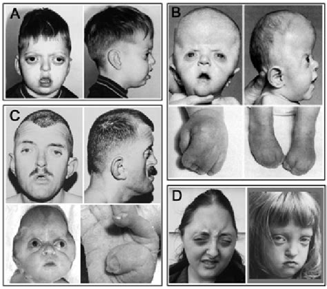 Craniosynostosis Resulting From Fgfr Mutations A Crouzon Syndrome B