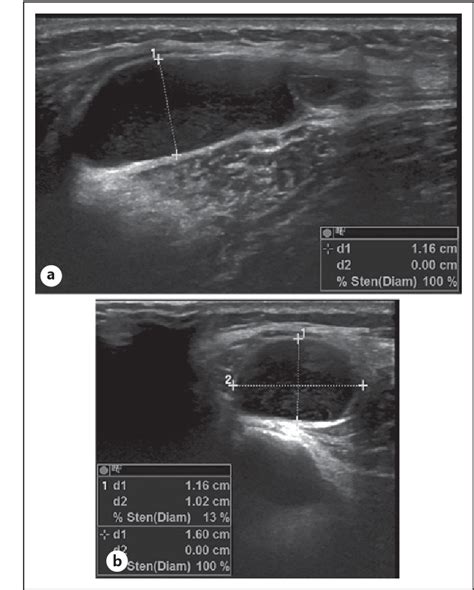 Figure 1 From Large Intraneural Ganglion Cyst In The Peroneal Nerve