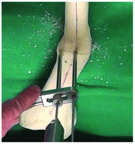 Execution Of The Focal Dome Osteotomy A Central Reference Drill Bit Is
