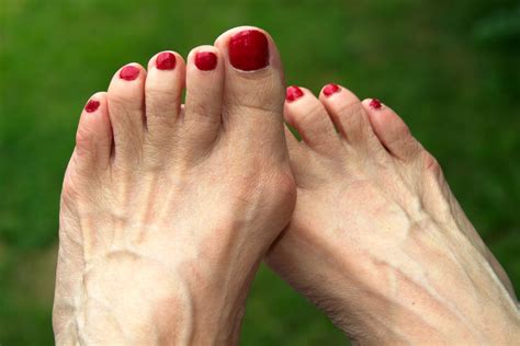 What Is A Bunion Celebration Foot Ankle Institute