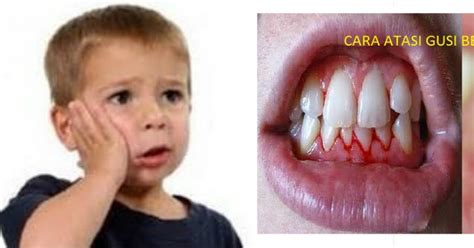 Cara mengobati gusi bengkak alami yang murah dan mudah didapat. Obat Gejala Radang Gusi Bengkak Pada Anak Herbal Terbaik ...