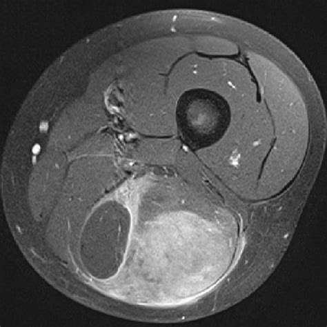 Axial Mri Of The Left Thigh Delineates An Ill Defining Tumor Mass