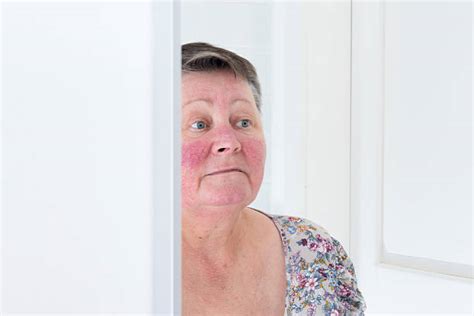3900 Rosacea Stock Photos Pictures And Royalty Free Images Istock