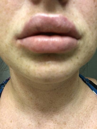 Why Do I Get White Spots Around My Lips