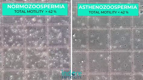 Asthenozoospermia Sperms With Low Motility Side By Side Comparison