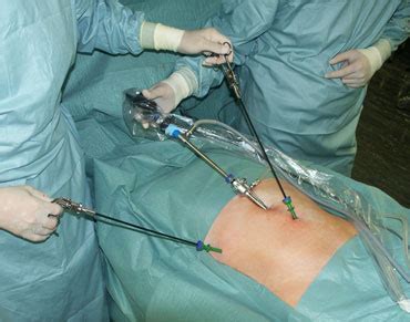 Eine entstehungsursache sind schwachstellen in der tragenden bauchwand (muskulatur / bindegewebe) in der leistengegend. Leistenbruch | Spital Thurgau AG
