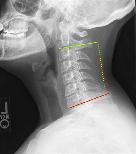 Magnetic Resonance Imaging Of The Cervical Spine Under Represents