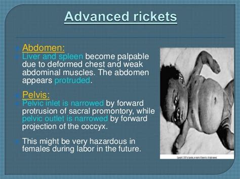 Rickets Lecture