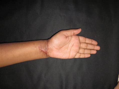 Sharp Cut Injury Wrist Median Nerve Injury Multiple Flexor Tendon
