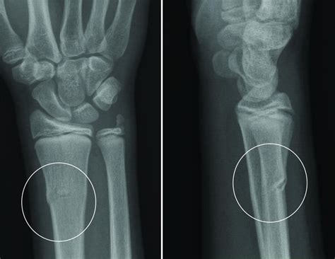 Buckle Fracture Raleigh Hand Surgery — Joseph J