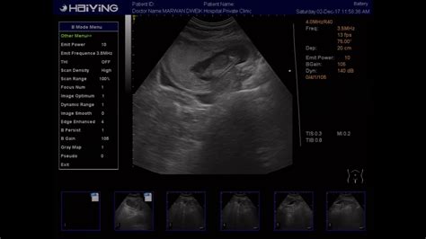 Ultrasoundfetal Abdominal Cyst Youtube
