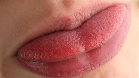 Swollen Taste Buds Inflamed Papillae On Back Of Tongue