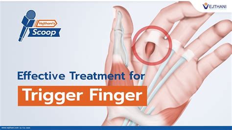 Effective Treatment For Trigger Finger Vejthanis Scoop Trigger