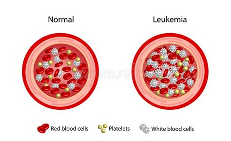 Leukemia Blood Cancer Difference Between Healthy Normal Blood And