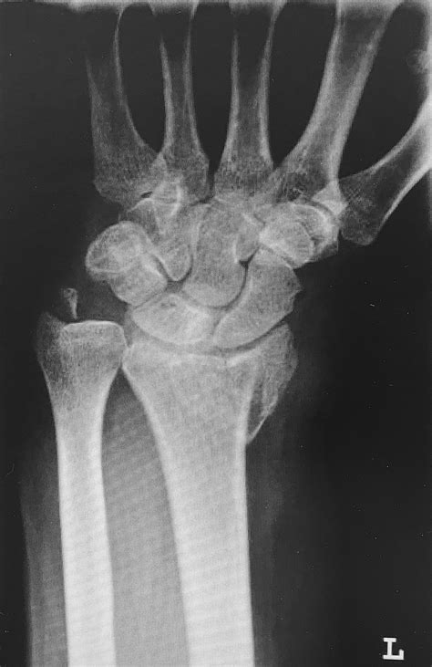 Röntgen Des Linken Handgelenkes Mit Darstellung Einer Distalen