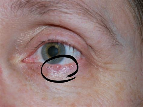 Basal Cell Carcinoma On The Lower Eyelid Part 1 Organized 31