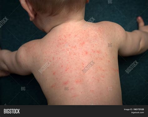 Allergies Pimples On Image And Photo Free Trial Bigstock