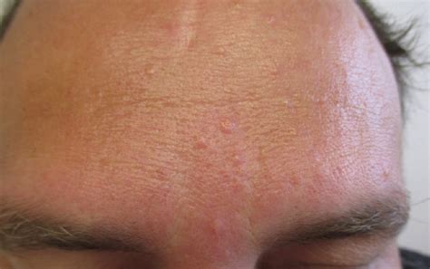 What Are These Small Bumps On My Face Sebaceous Hyperplasia By Joanna