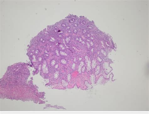 Ulcerated Colonic Tissue With Marked Chronic Active Colitis Cryptitis