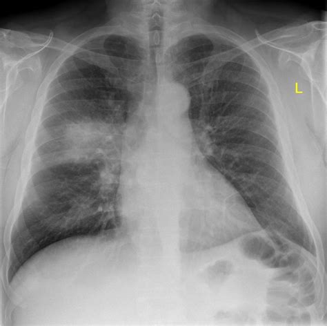 Right Upper Lobe Pneumonia Radiology Case
