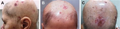 Multiple Basal Cell Carcinomas On Facial A And Scalp B C Skin