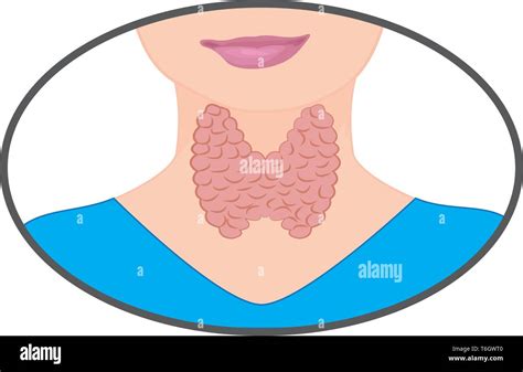 Goiter Enlarged Thyroid Endocrine Disfunction Vector Illustration On