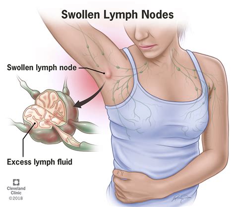 Swollen Lymph Nodes Lymphadenopathy