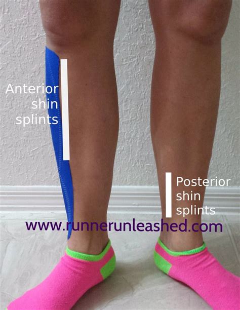 Anterior And Posterior Shin Splints Causes Symptoms And Advice And