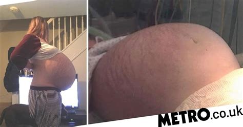Woman With Ovarian Cyst The Size Of Seven Newborn Babies Thought She