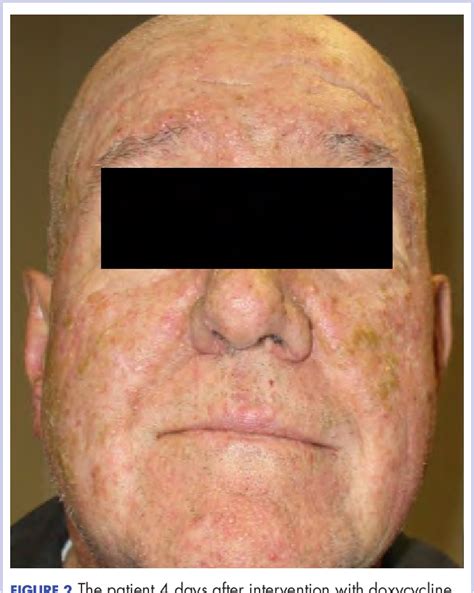Figure 2 From The Challenge Of Managing A Cetuximab Rash Epidermal