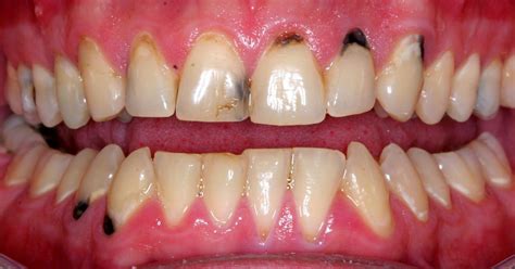 Brown Spots On Teeth Near Gums Lasopasoccer