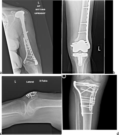Surgical Treatment Of Osteoporotic Fractures An Update On The