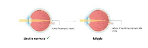 Differenza Tra Presbiopia Miopia Astigmatismo E Ipermetropia Blog