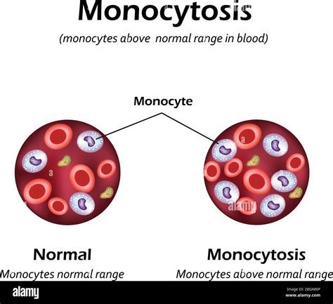 Monocytes Above The Normal Range In The Blood Monocytosis Vector