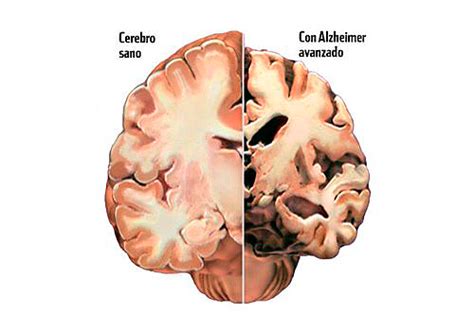 5 Datos Importantes Que Debes Conocer Sobre El Alzheimer National