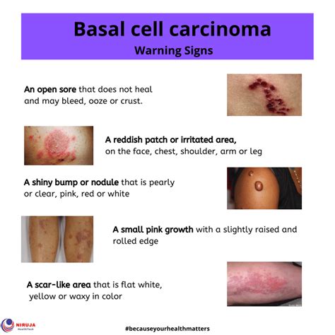 Basal Cell Carcinoma Niruja Healthtech