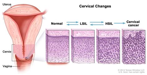 Hpv And Pap Test Results Next Steps After An Abnormal Cervical Cancer