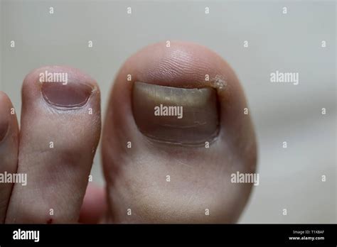 Bruised Toenail Hi Res Stock Photography And Images Alamy