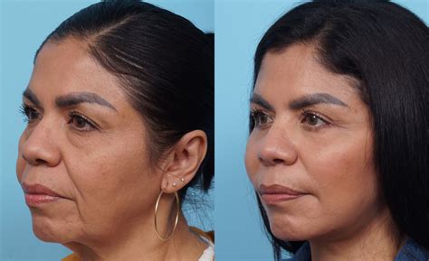 Facial Fat Transfer Balikian Plastic Surgery San Diego