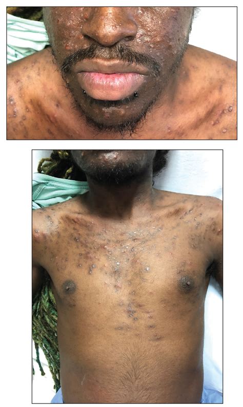 Pruritic Papules On The Face And Chest Mdedge Dermatology