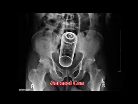 World S Rarest X Ray Shows Unbelievable Foreign Objects In Human Rectum