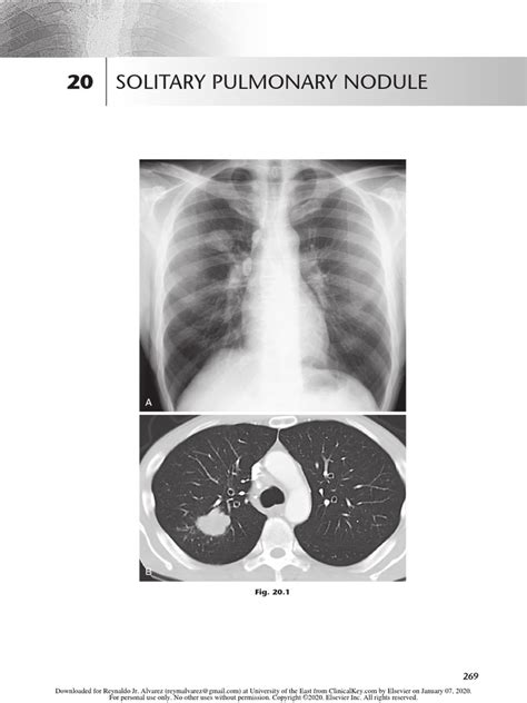 Chest Radio 20 Solitary Pulmonary Nodule Pdf Lung Cancer Ct Scan