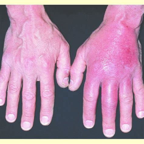 Cellulitis In A Patients Hand Causing Redness And Inflammation Note