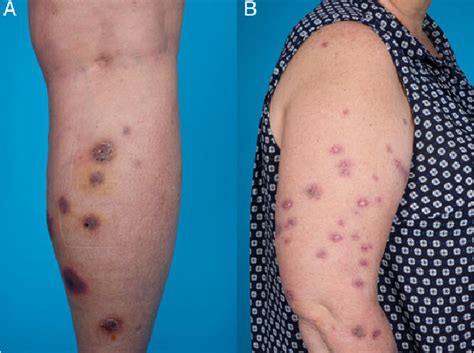 Figure 1 From Disseminated Cutaneous Mycobacterium Chelonae Infection