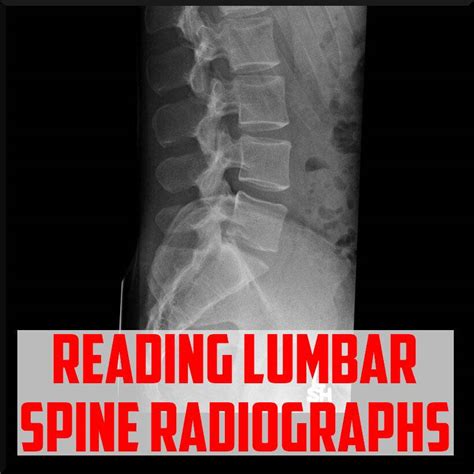 A Review On Reading Lumbar X Rays Sports Medicine Review