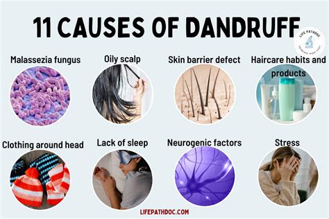11 Causes Of Dandruff What Exactly Is It